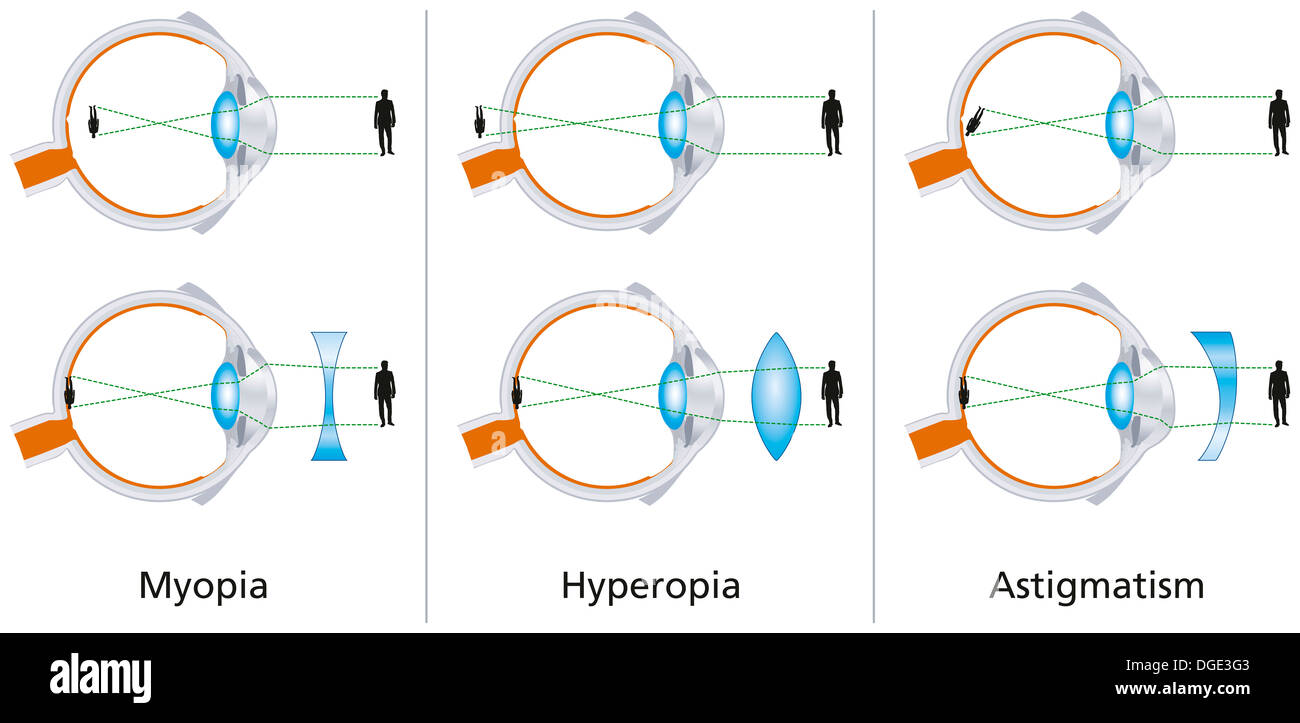 Visual Defects - Myopia, Hyperopia And Astigmatism Stock Photo