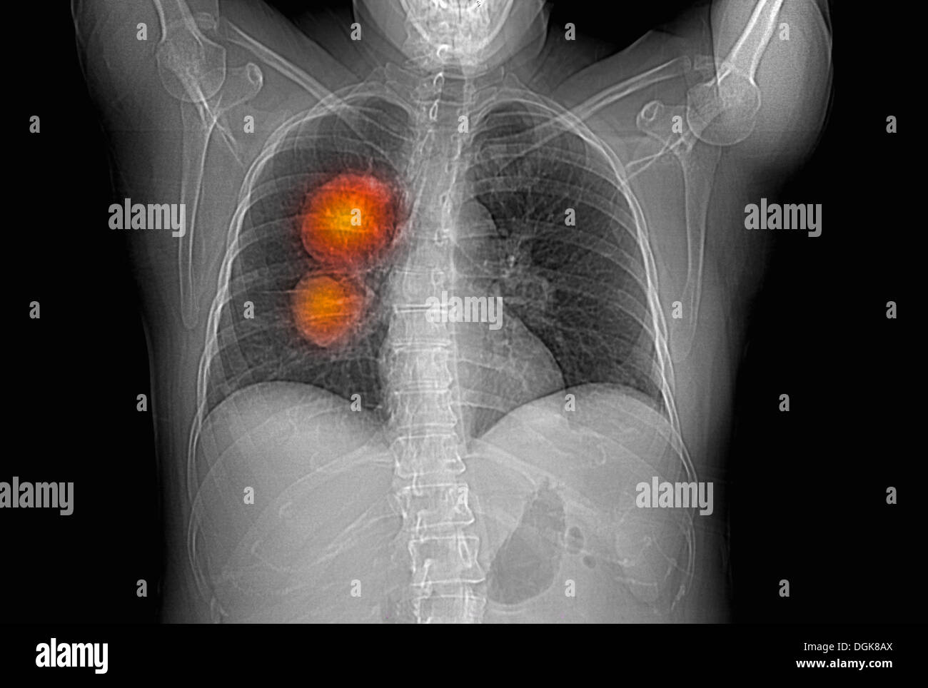 Metastatic melanoma of the lungs Stock Photo Alamy