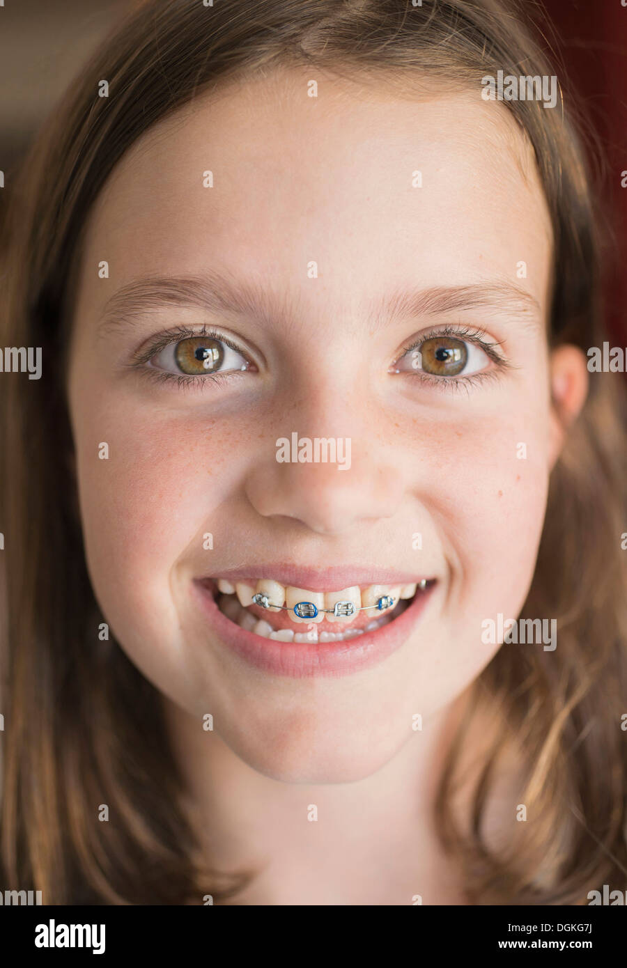 Braces open mouth smile hires stock photography and images Alamy