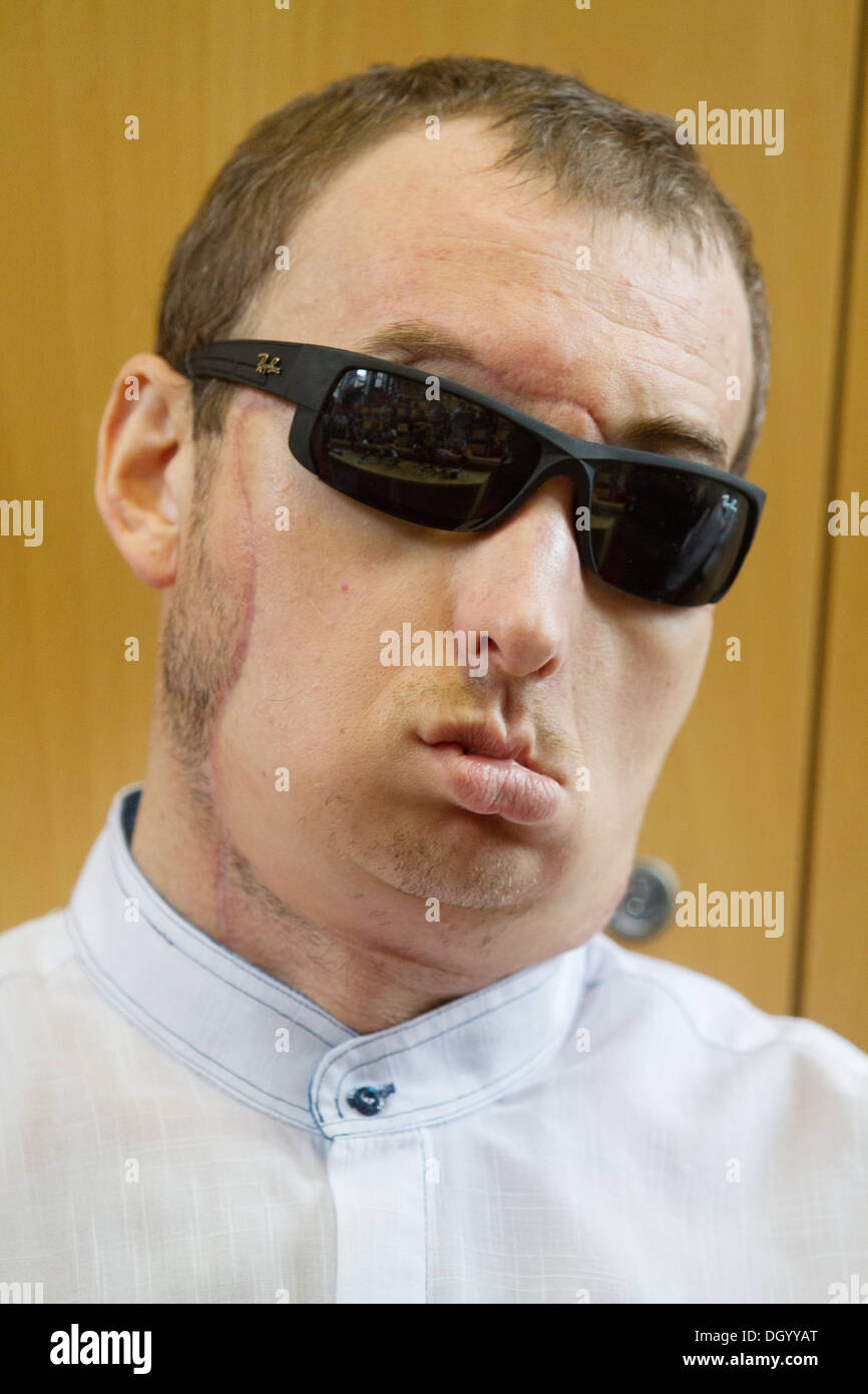 A man after face transplant during press conference in Gliwice , Poland