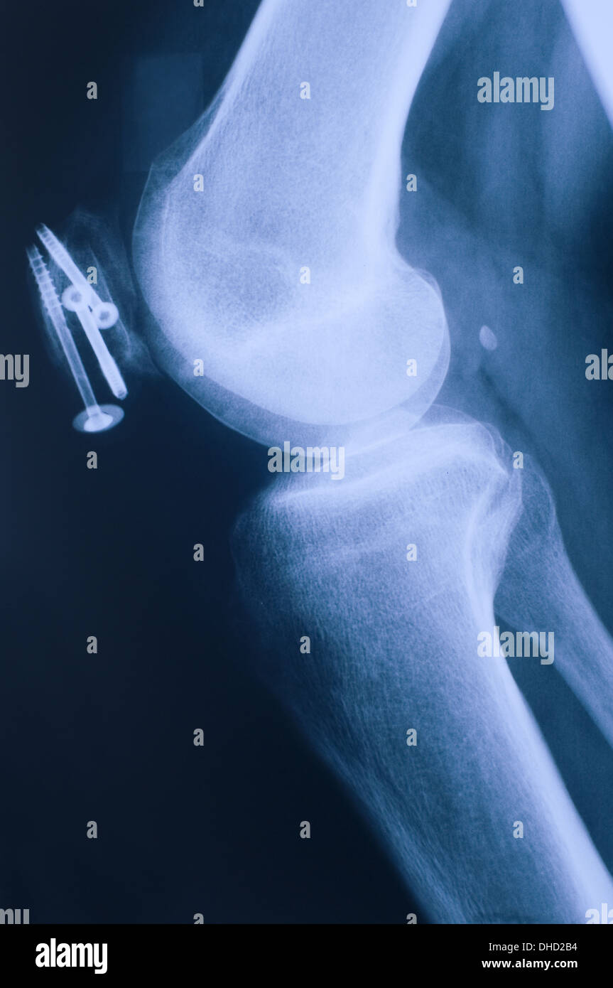 x-ray of knee with screws lateral Stock Photo