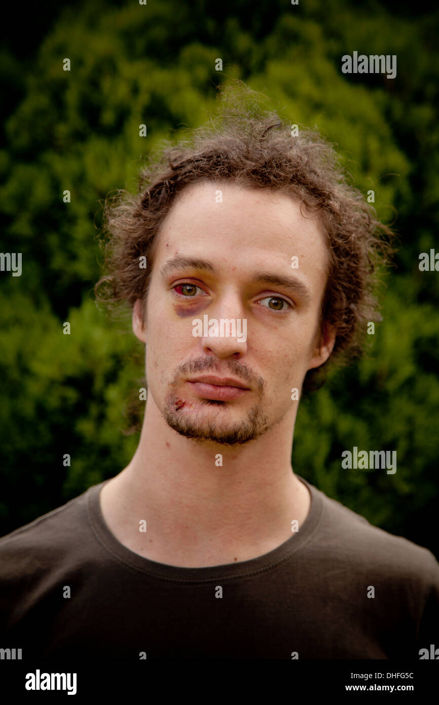 Young man with black eye Stock Photo - Alamy