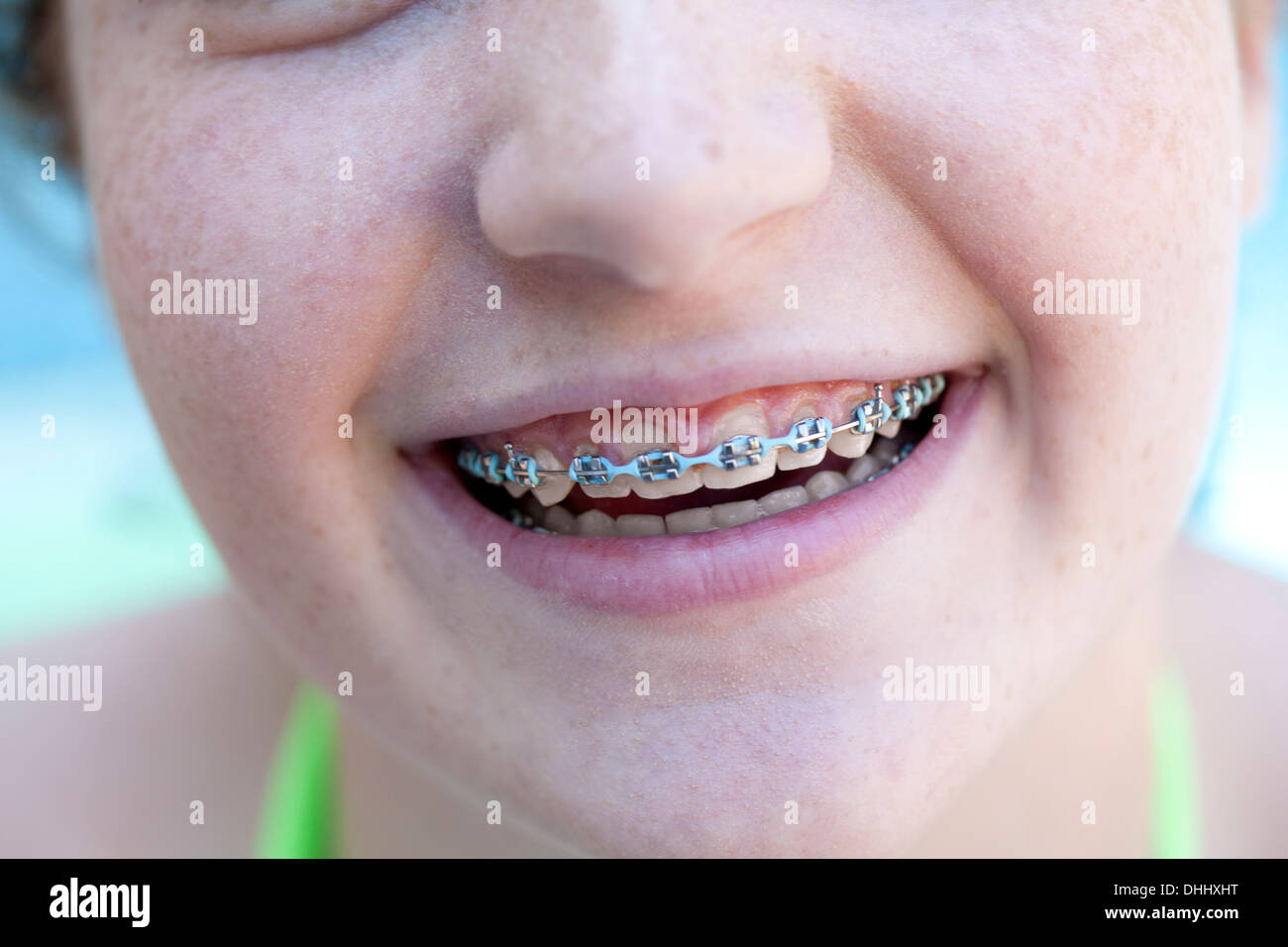 Girl with dental braces Stock Photo
