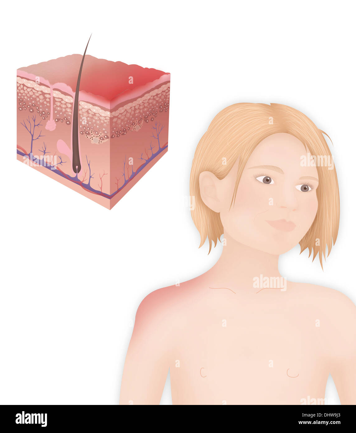 Girl skin sunburn illustration hi-res stock photography and images - Alamy