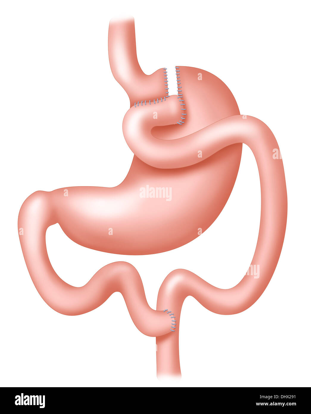 GASTRIC BYPASS Stock Photo