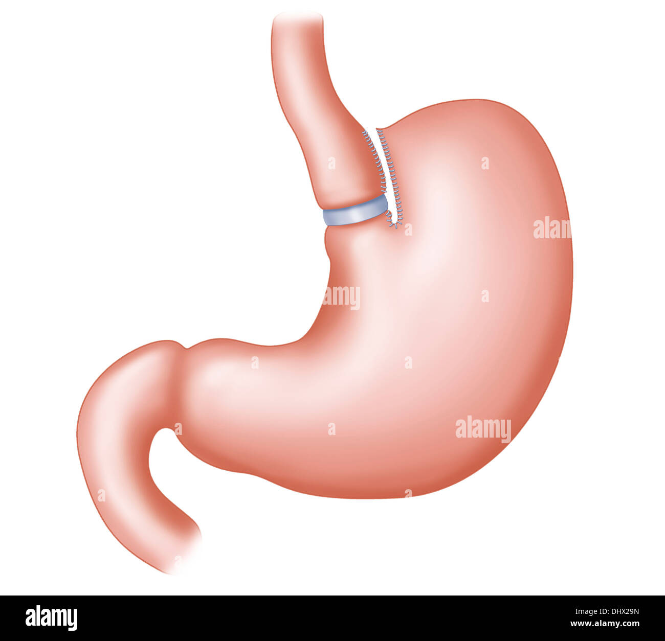 VERTICAL BANDED GASTROPLASTY Stock Photo