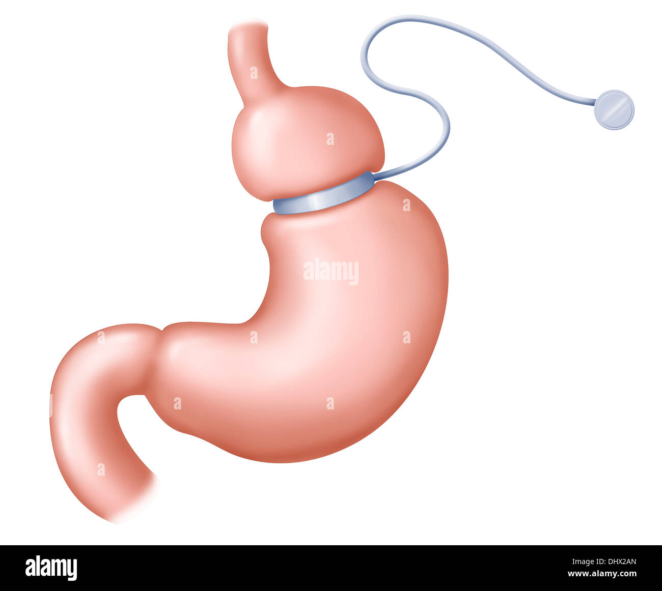 GASTRIC BAND Stock Photo