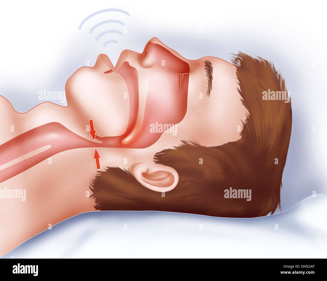 Сон нос мужчины. Остановка дыхания во сне. Храп остановка дыхания. Обструктивное апноэ.