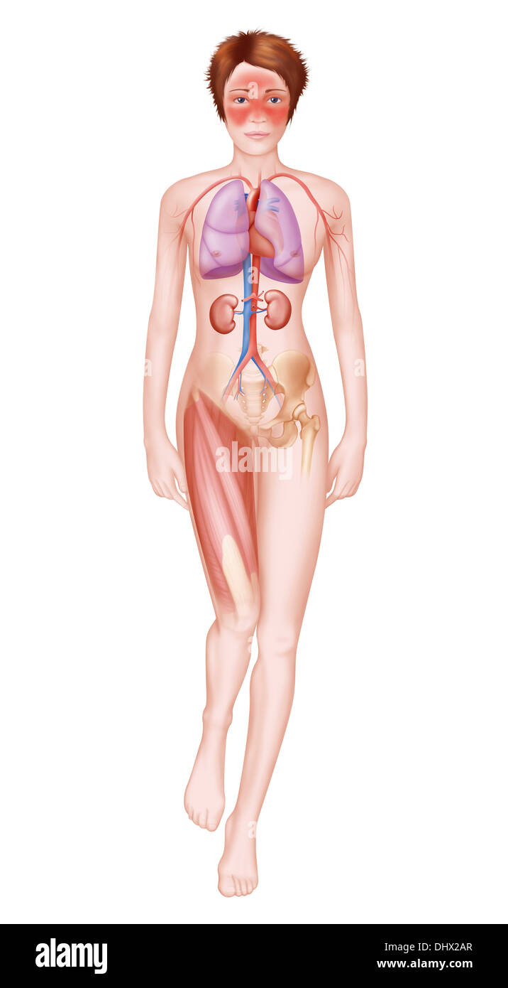 SYSTEMIC LUPUS ERYTHEMATOSUS Stock Photo