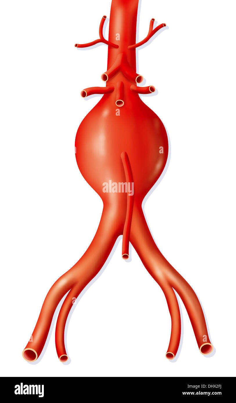 ANEURYSM OF AN ARTERY, DRAWING Stock Photo