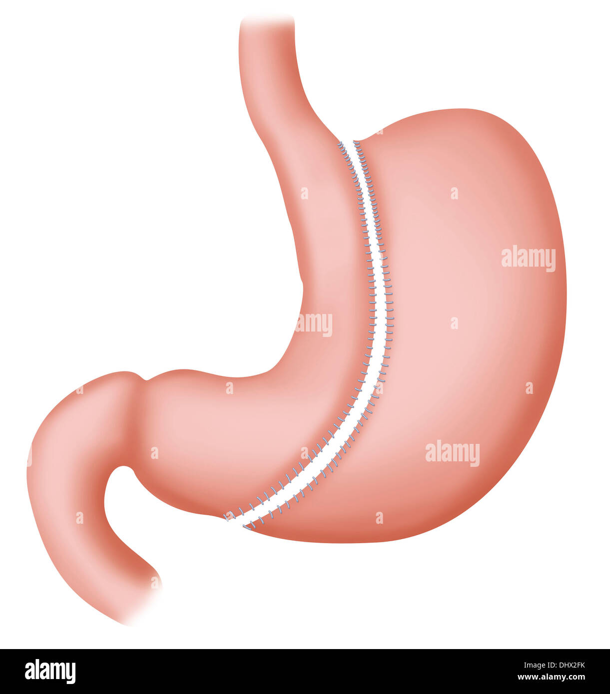 SLEEVE GASTRECTOMY Stock Photo