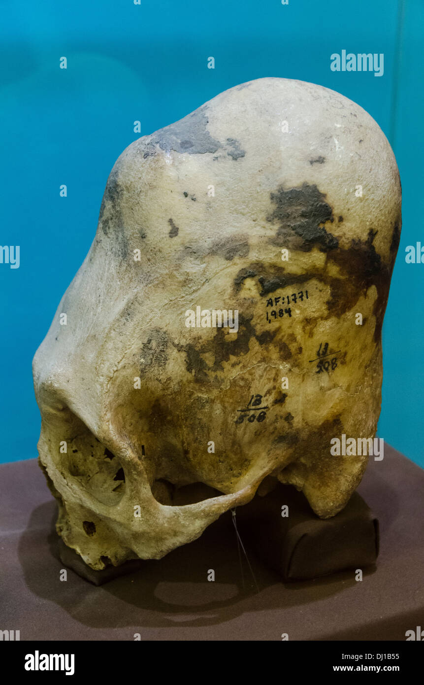 Deformed skulls of Paracas. Stock Photo