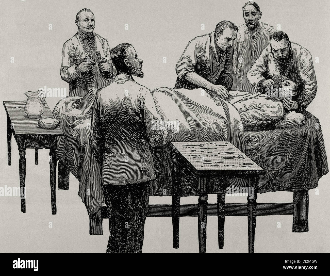 History of medicine. Chloroform anesthesia. Engraving, 19th century. Stock Photo