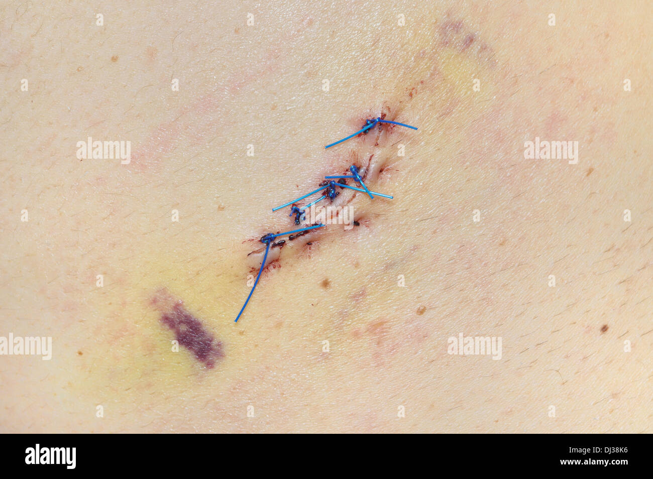Close-up of stitched wound after skin biopsy on men's back. Skin nevus removed to be sent to a pathologist. Stock Photo