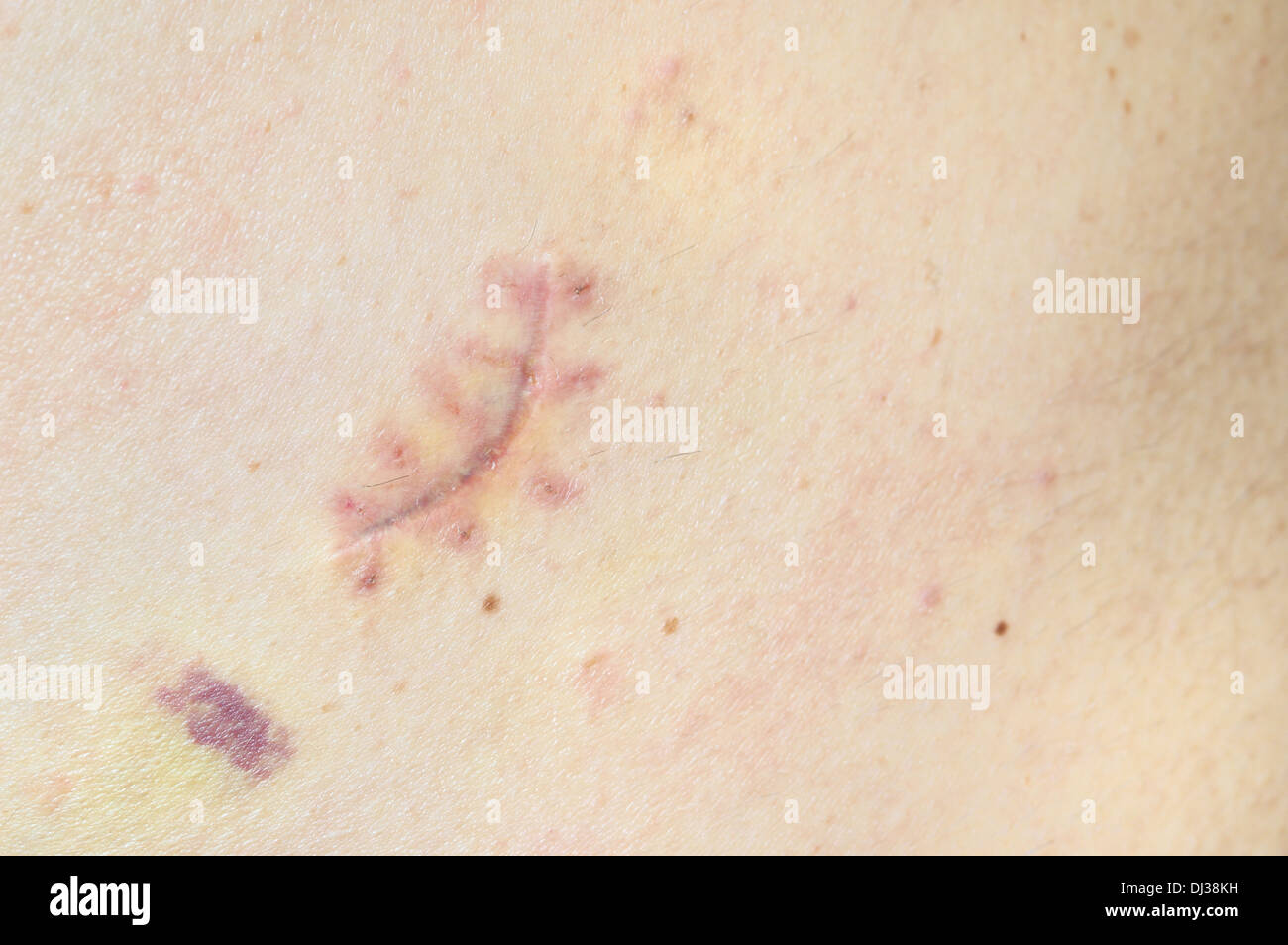 Close-up of a fresh scar on a male back. Skin nevus removed. Stock Photo