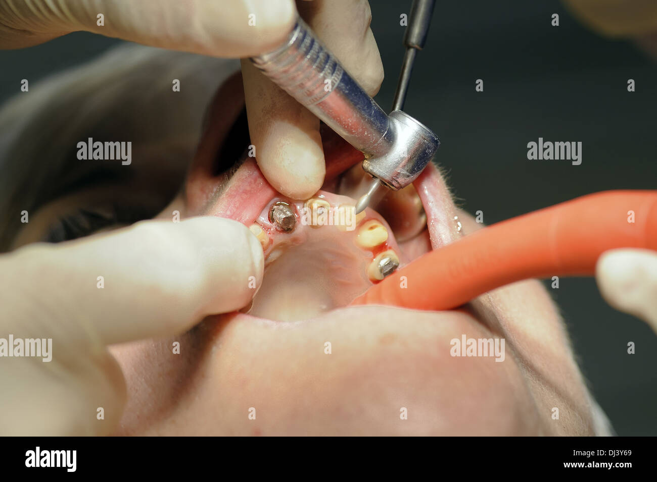 Close up of a dental treatment Stock Photo