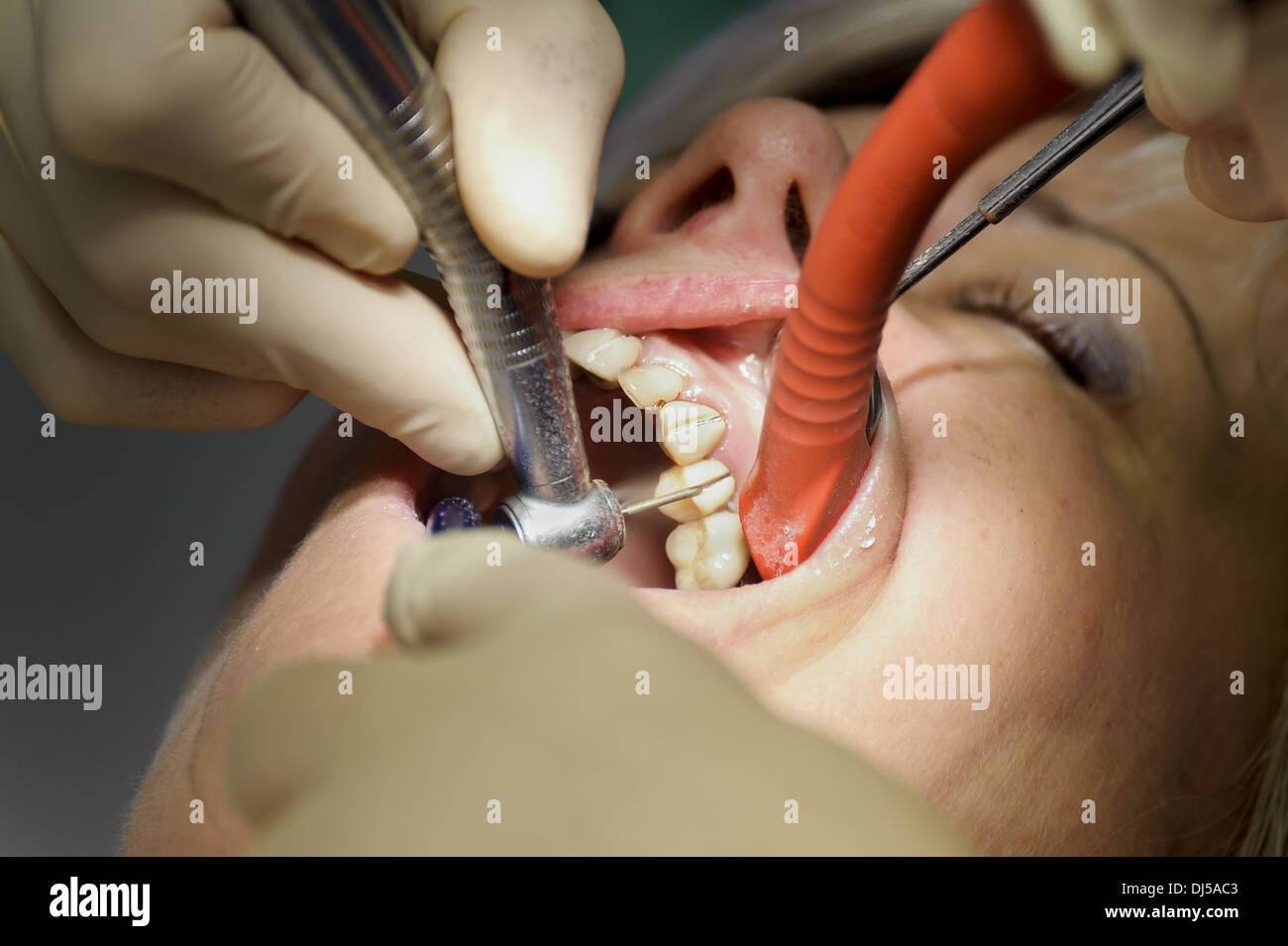 Dentist separated on dental crowns Stock Photo