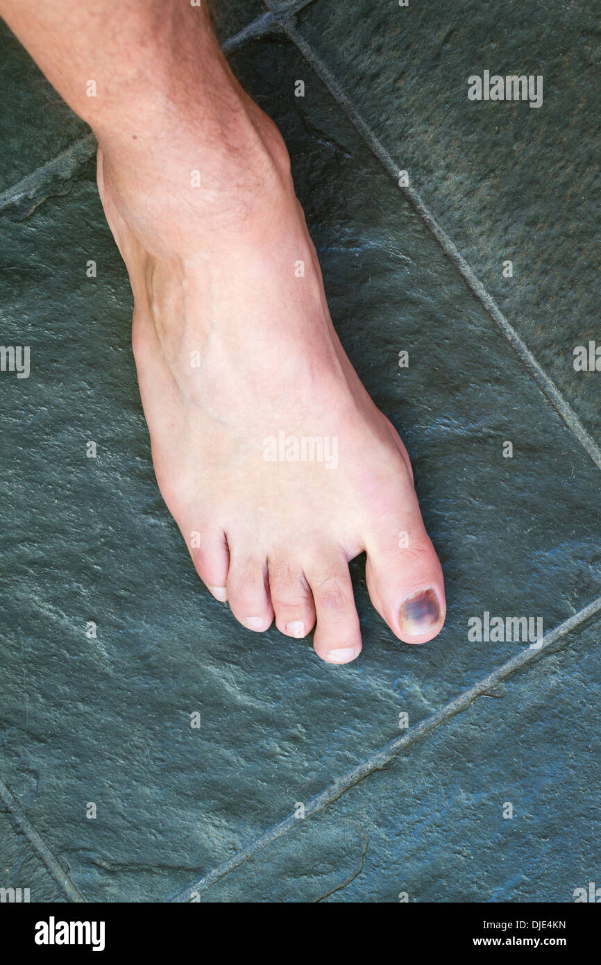 Bruise under the big toenail Stock Photo Alamy