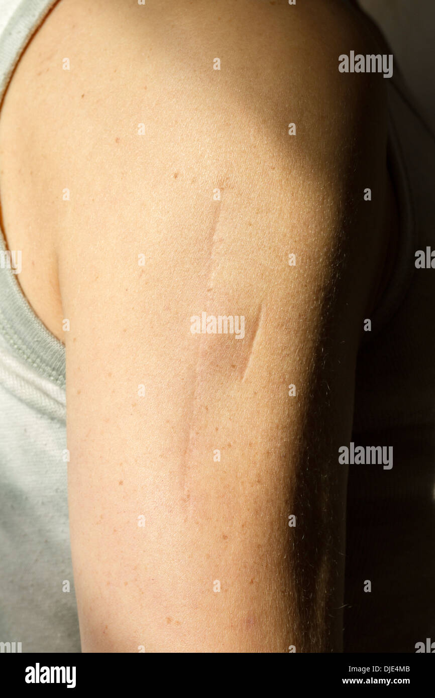Scars on woman's upper arm Stock Photo
