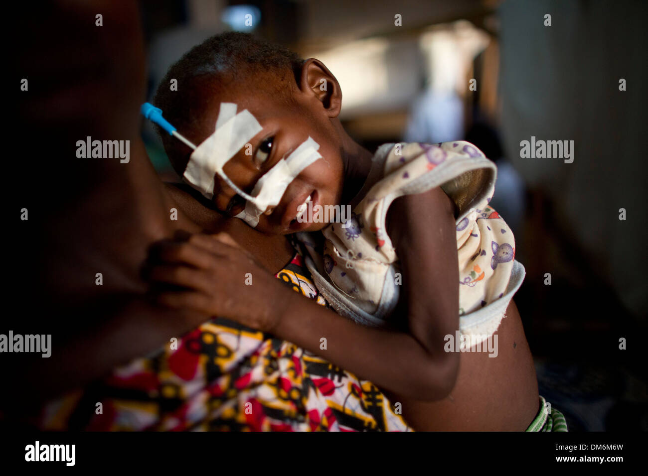 malnourished child at MSF hospital in central african republic Stock Photo