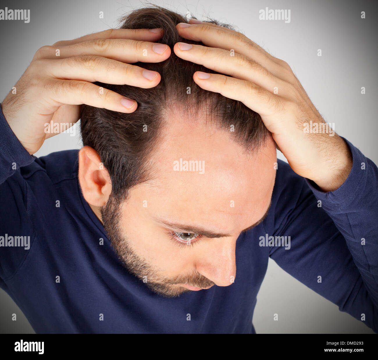 Caucasian young man controls hair loss Stock Photo