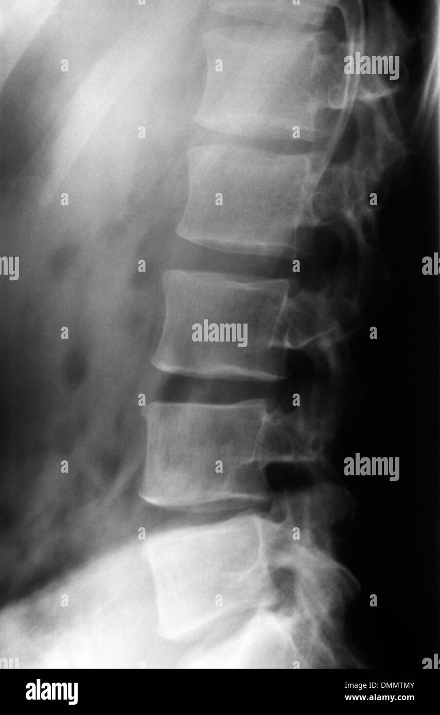 Radiograph of lumbar spine Stock Photo