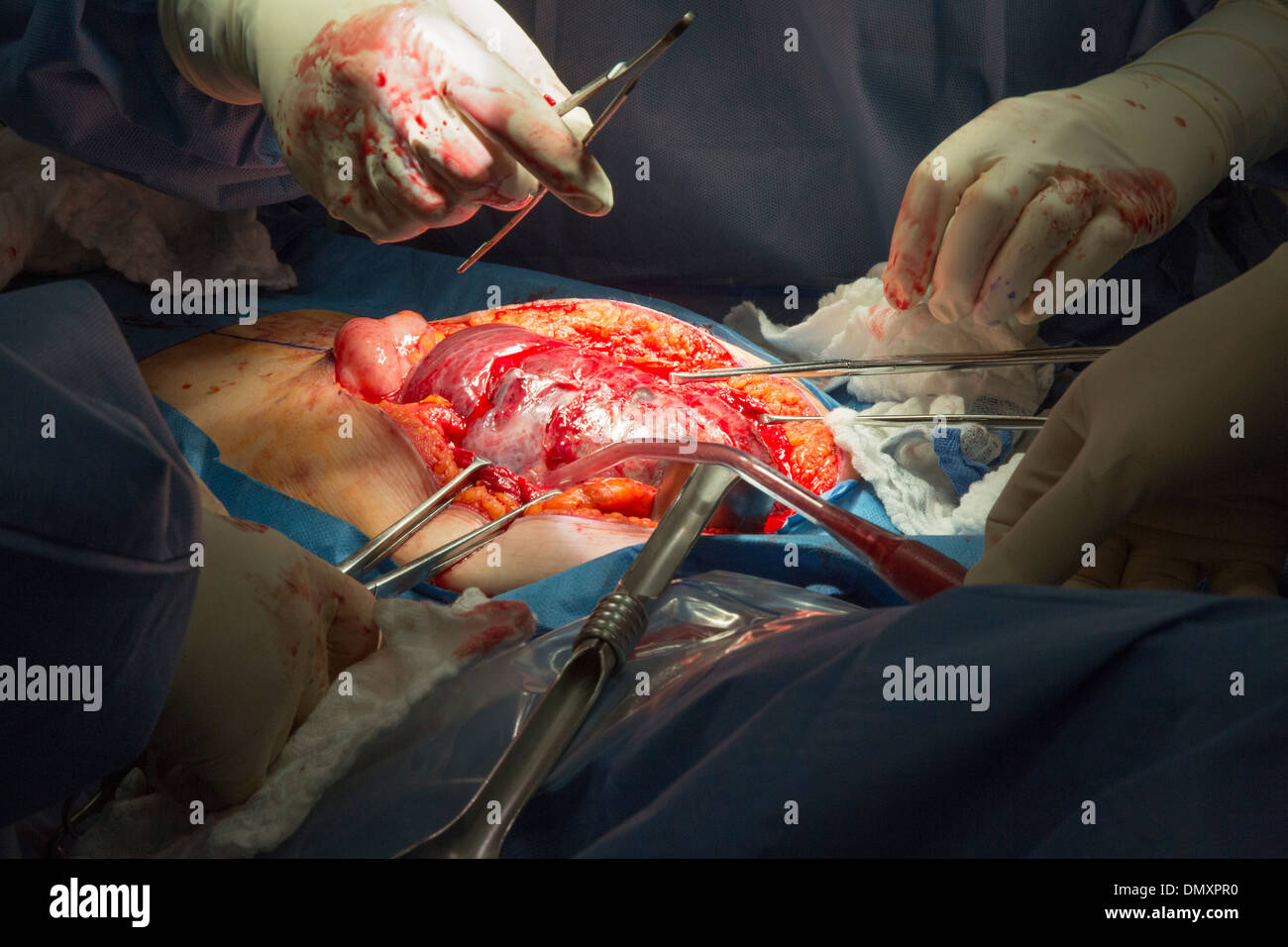 Surgeons perform a hysterectomy on a woman with endometrial cancer. Stock Photo