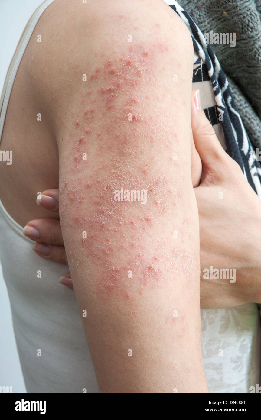 allergic rash dermatitis skin texture of patient Stock Photo