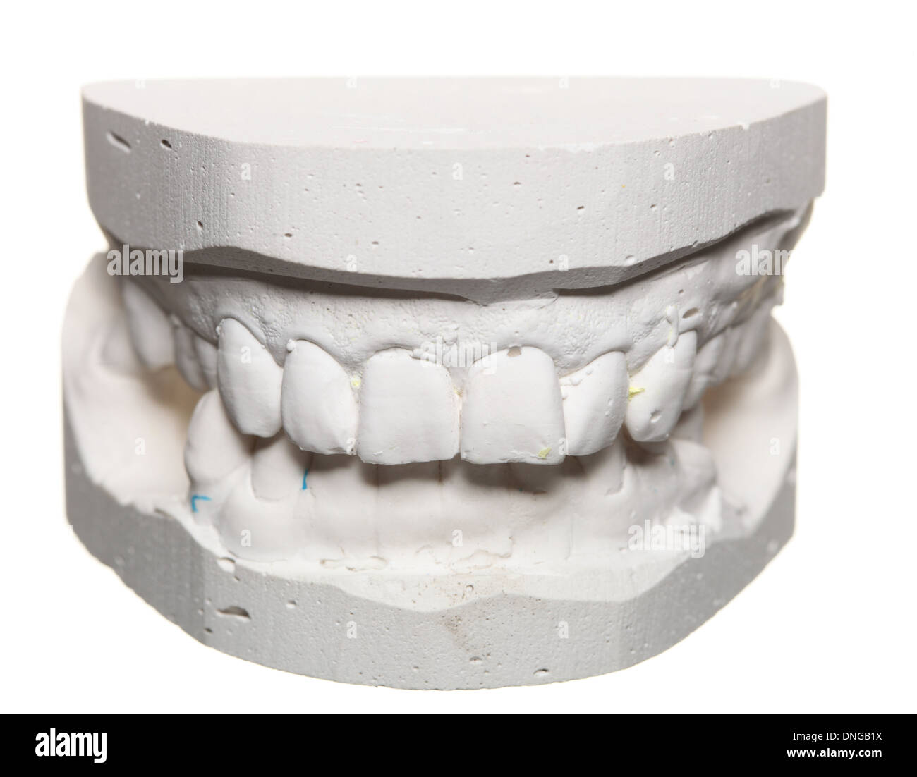 Mold of teeth. Gypsum model plaster of teeth. Stomatologic plaster cast,  molds of human jaws and teeth on gray background. Dentistry and  orthodontics concept Stock Photo