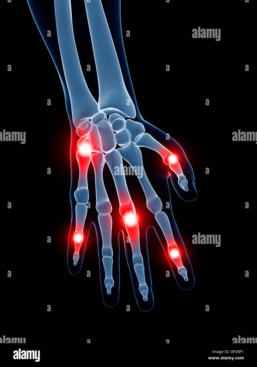 painful-finger-joints-artwork-stock-photo-alamy