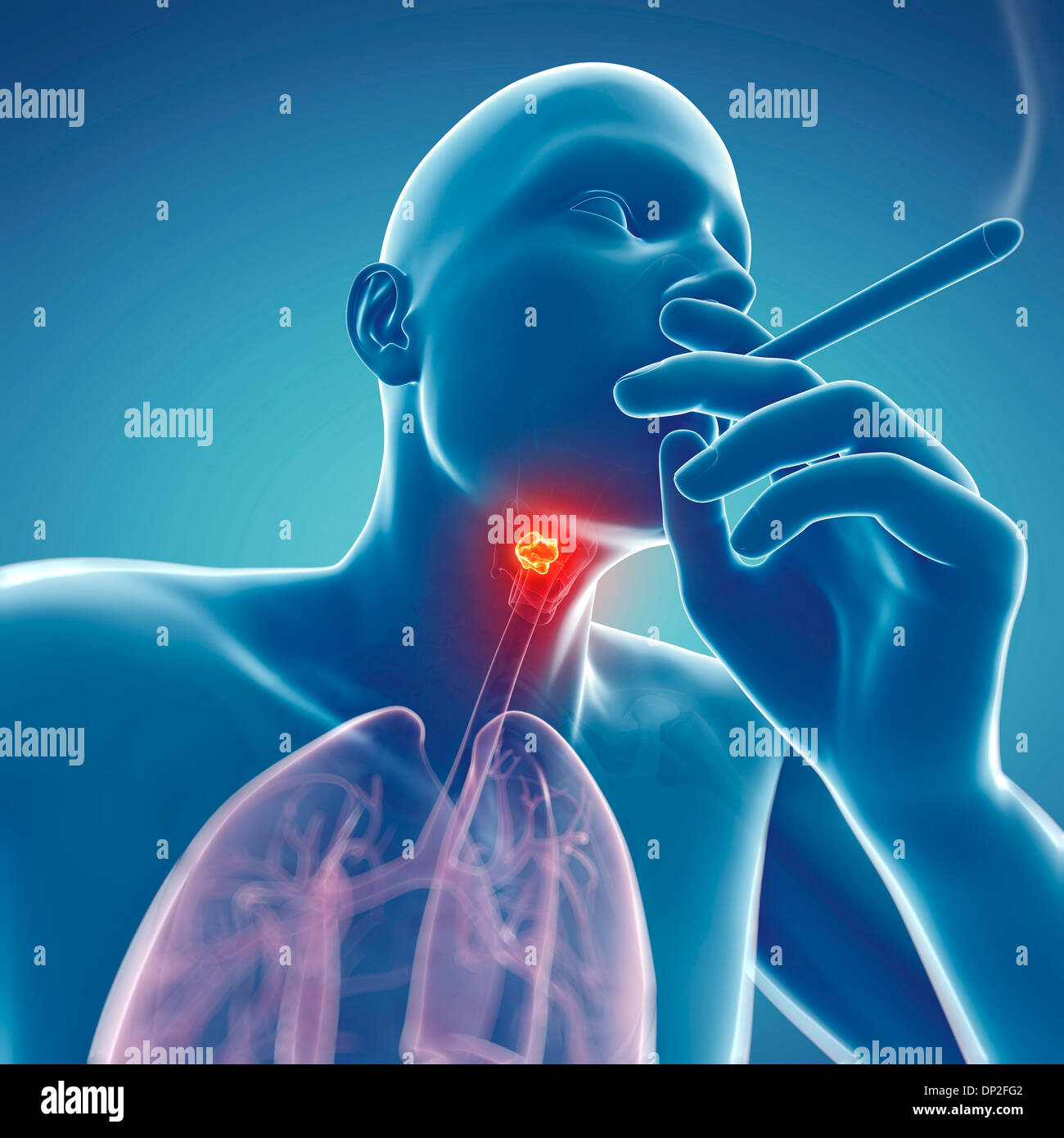 Larynx cancer, artwork Stock Photo Alamy