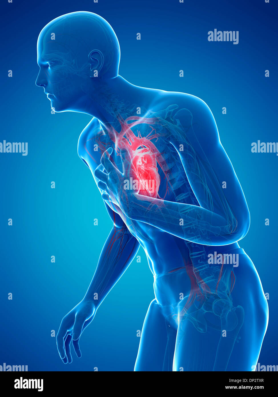 Heart attack, artwork Stock Photo - Alamy