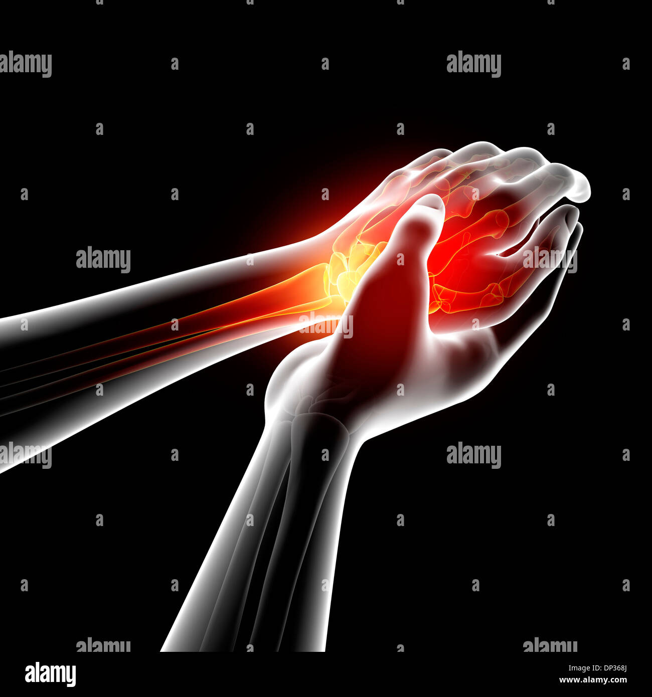 Wrist pain, artwork Stock Photo Alamy