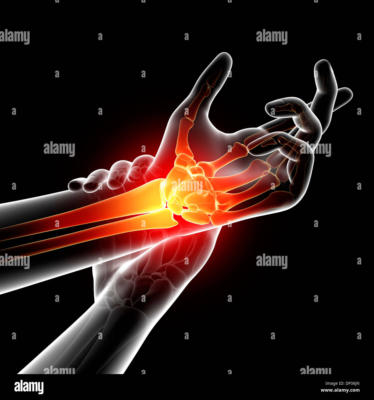 Wrist pain, artwork Stock Photo Alamy