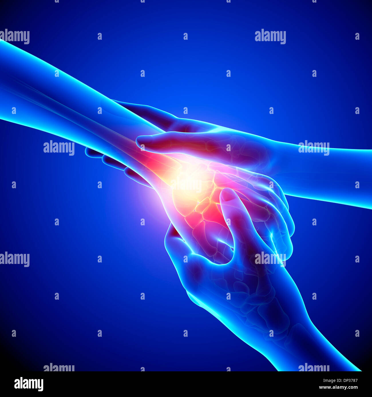 Wrist tendonitis hires stock photography and images Alamy