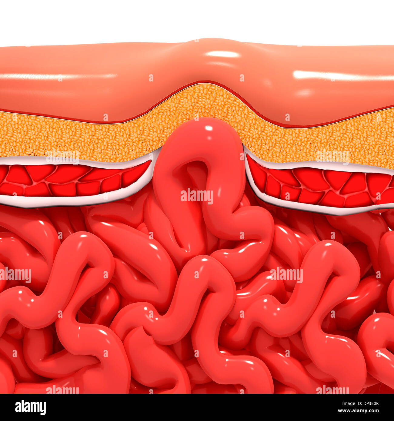 Ventral hernia, artwork Stock Photo