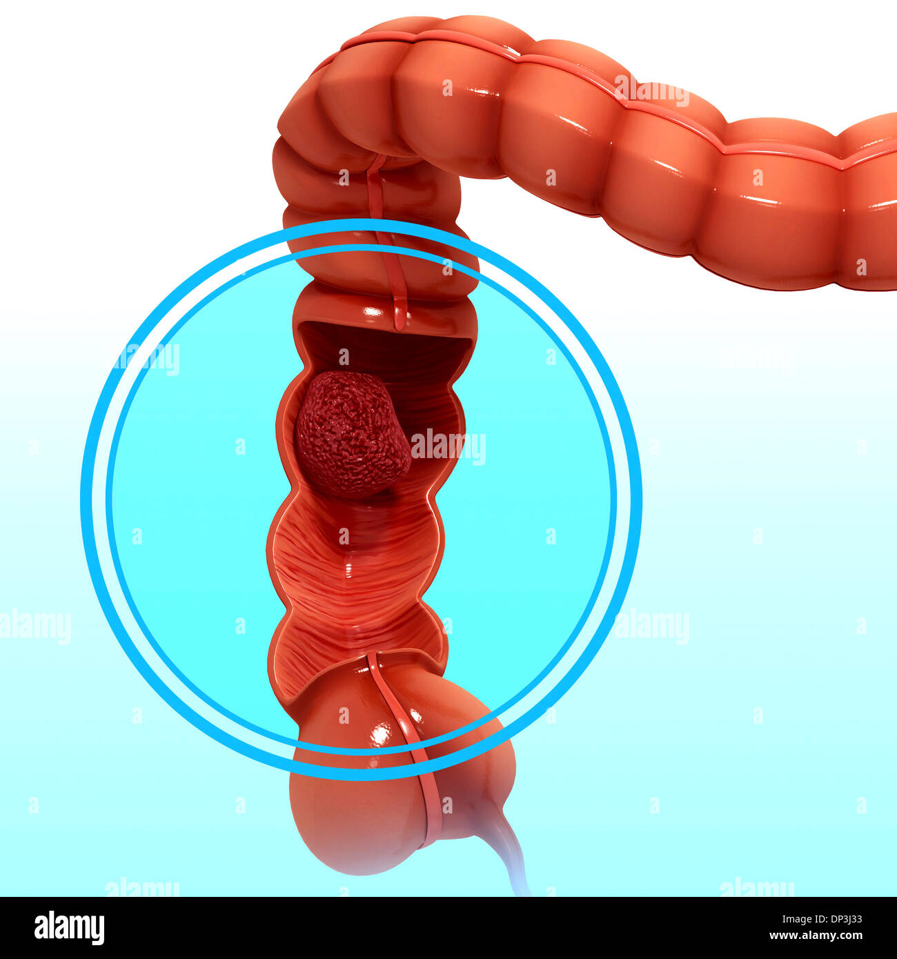 Damage Colon Abnormal colon hi-res stock photography and images - Alamy