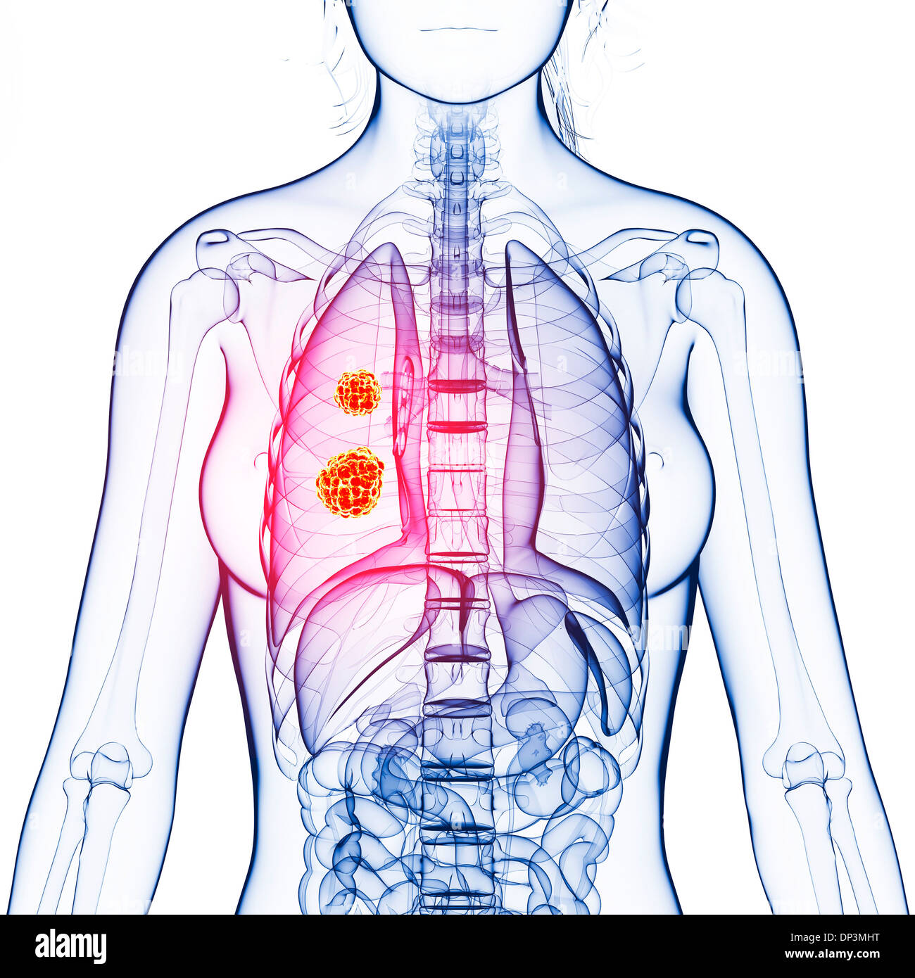 Lung cancer, artwork Stock Photo - Alamy