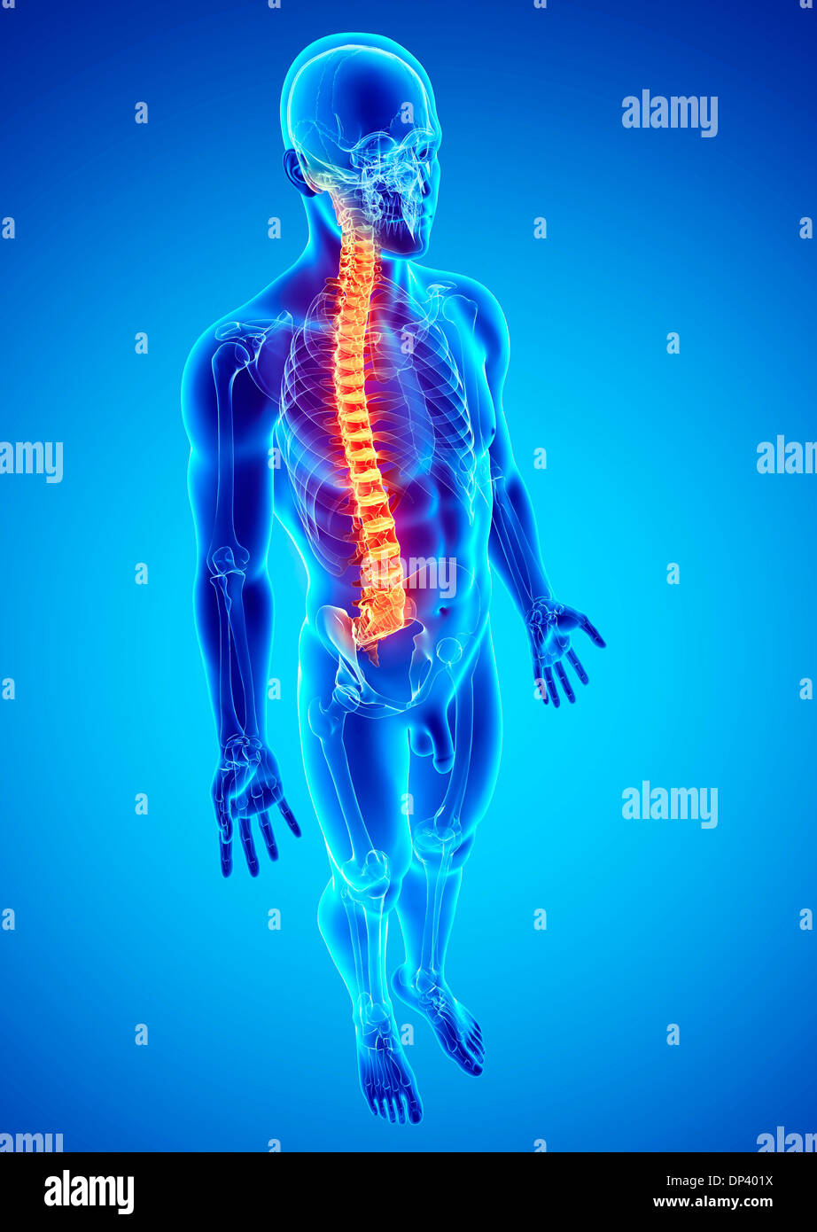 Spine disorder hi-res stock photography and images - Alamy