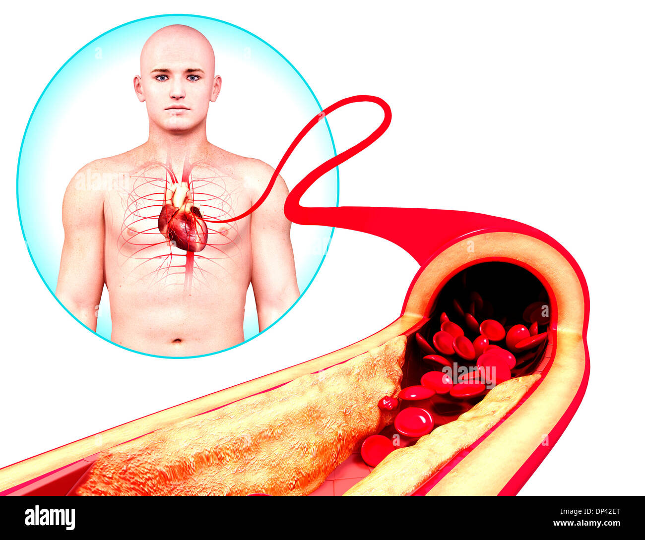 Atherosclerosis artwork hi-res stock photography and images - Alamy