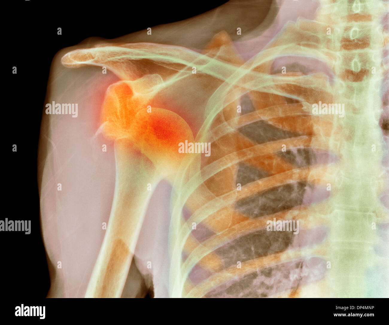 Dislocated shoulder, X-ray Stock Photo