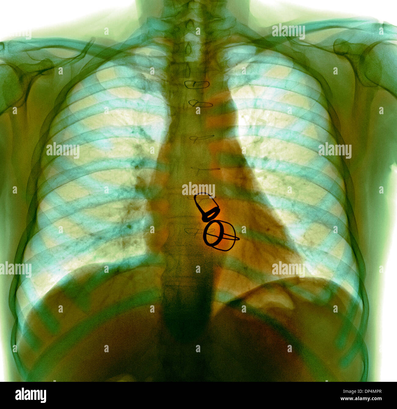 Prosthetic heart valves, X-ray Stock Photo