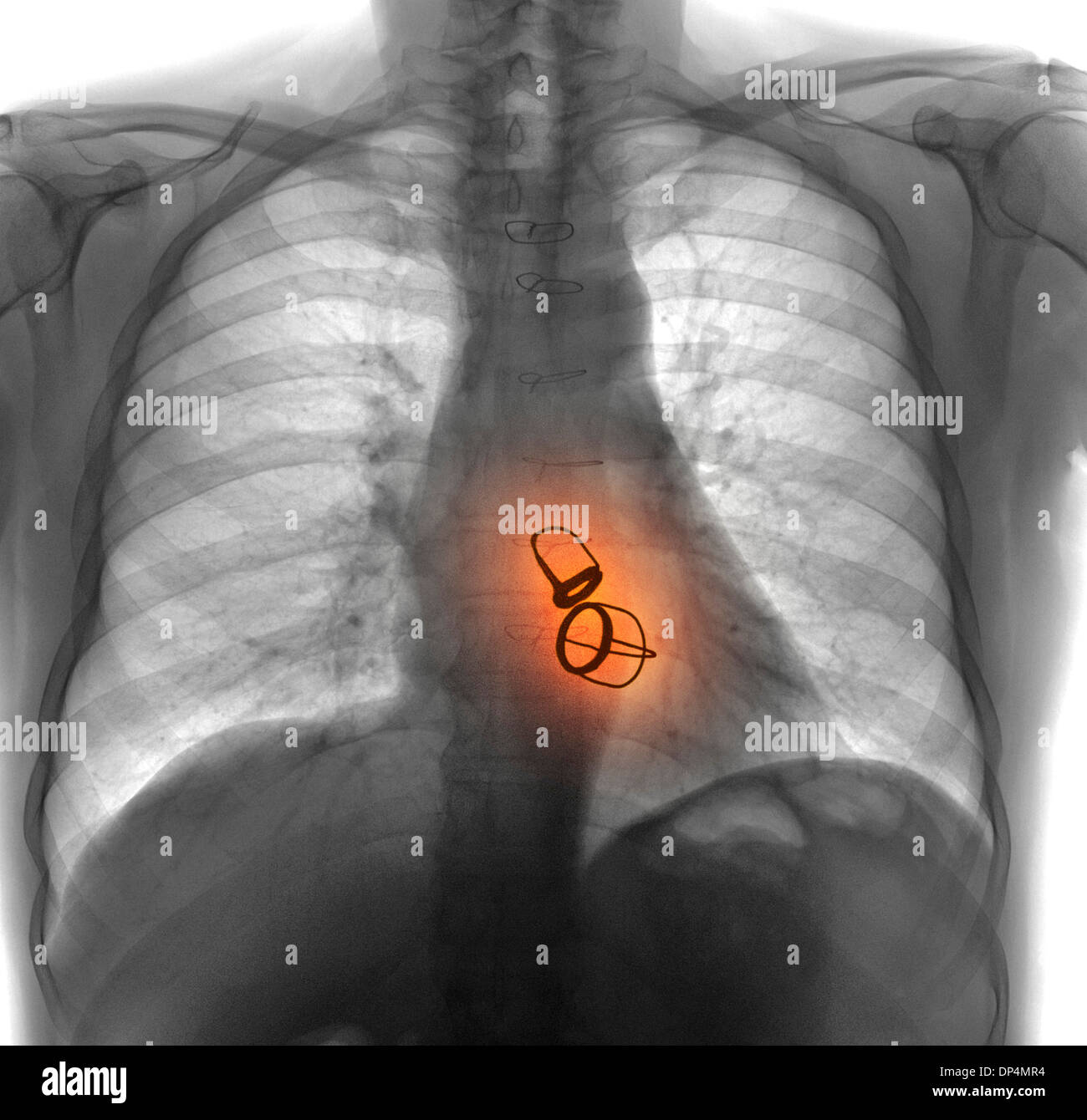 Prosthetic heart valves, X-ray Stock Photo