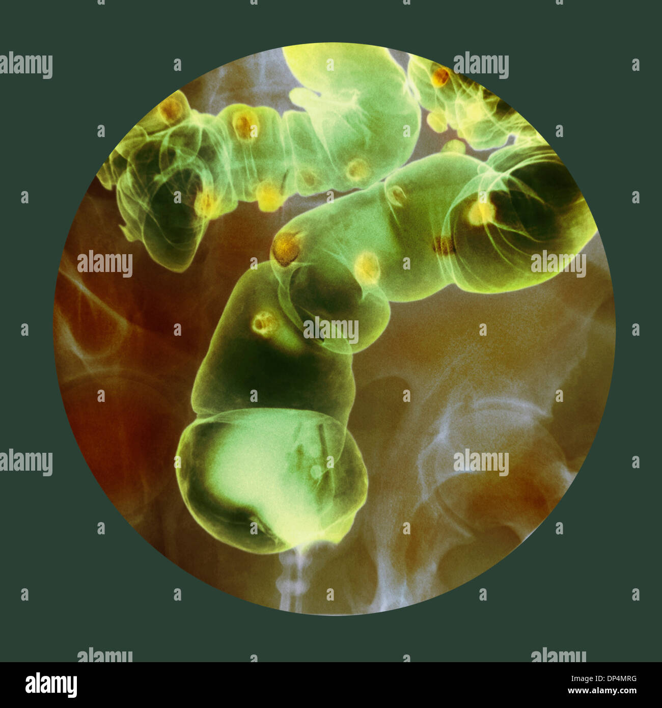 Diverticulitis colon hires stock photography and images Alamy