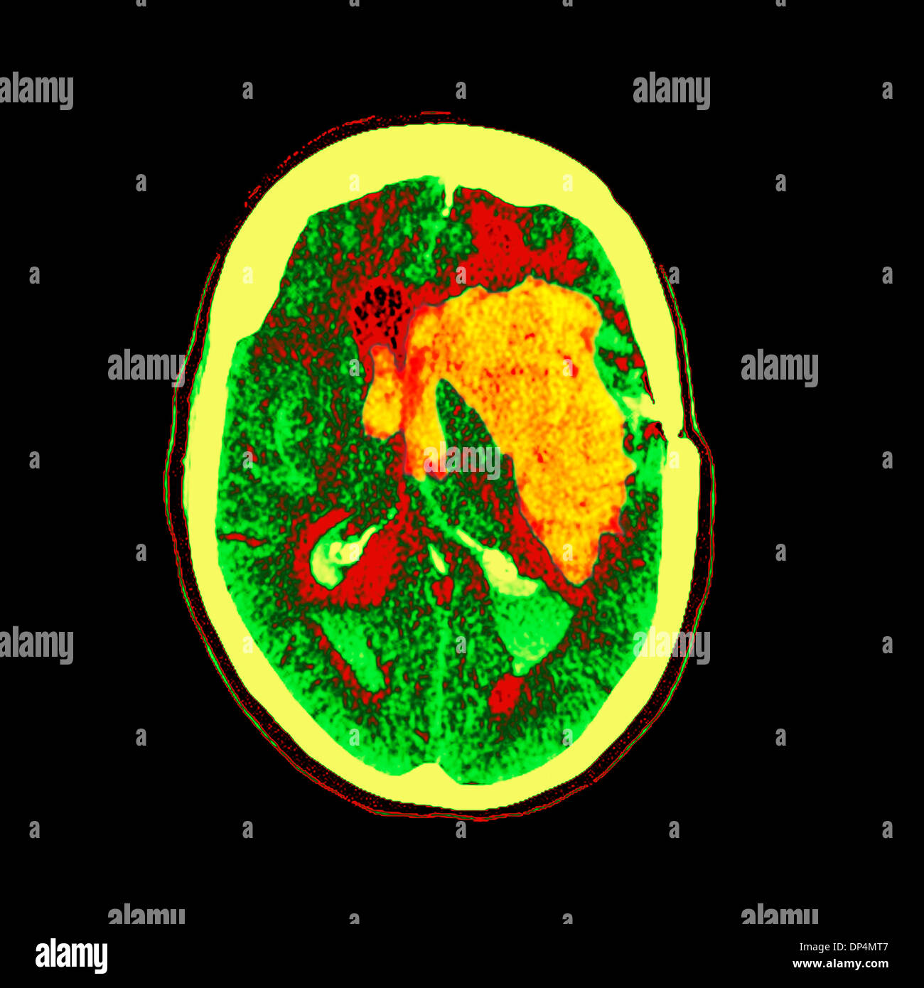 Brain haemorrhage, MRI scan Stock Photo