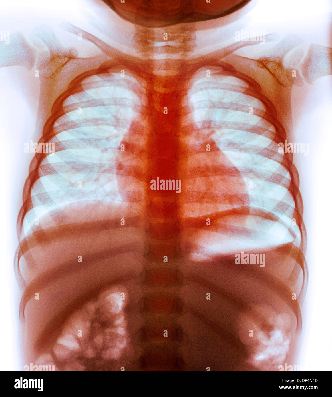 Child swallowed coin hires stock photography and images Alamy