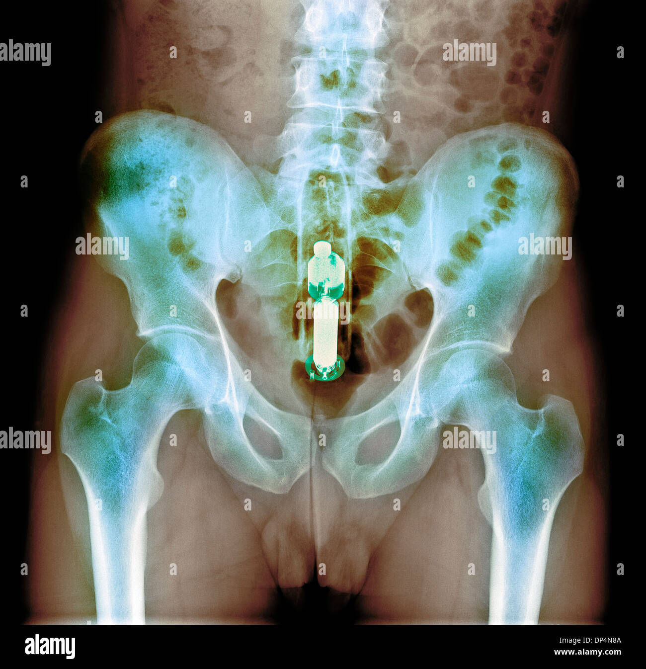 Foreign object in rectum, X-ray Stock Photo