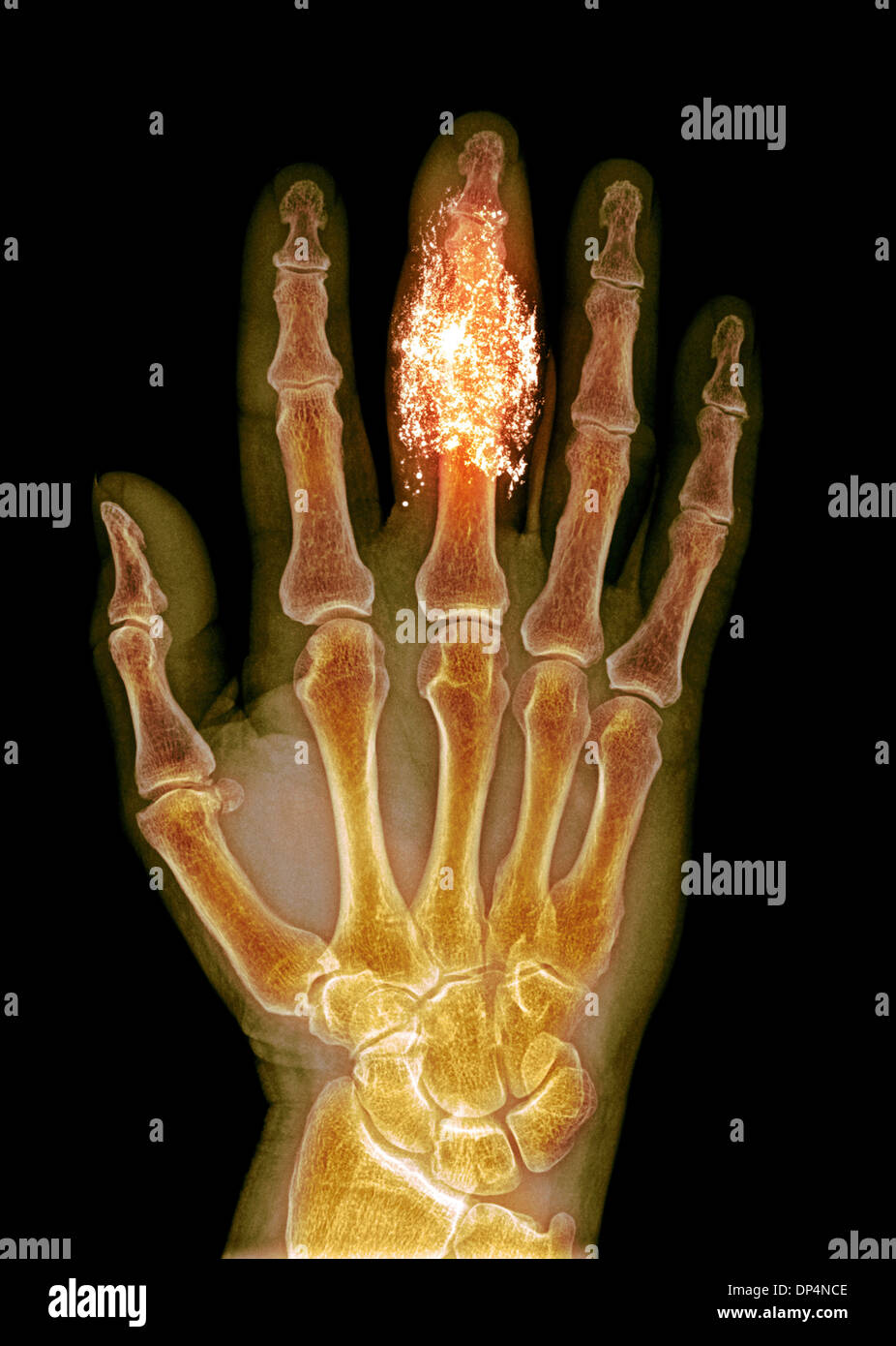 Foreign body in finger, X-ray Stock Photo