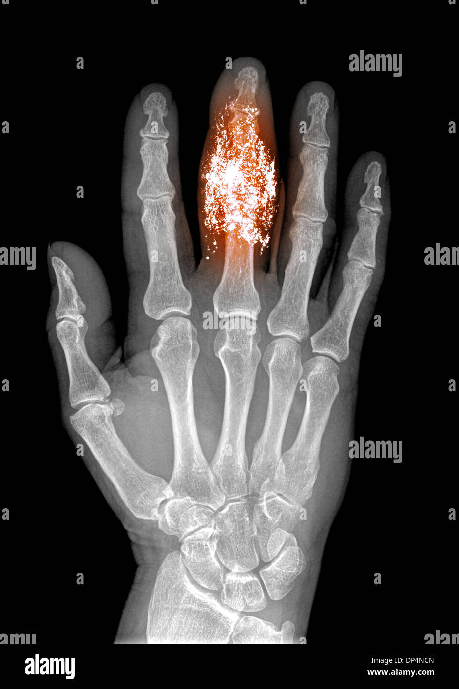 Foreign body in finger, X-ray Stock Photo