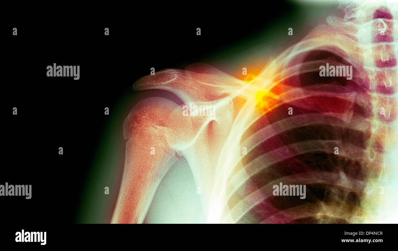 Fractured collarbone, X-ray Stock Photo